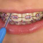 Nasveti iz ordinacije: To so koraki za zdrave in lepe zobe 1