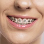 Nasveti iz ordinacije: To so koraki za zdrave in lepe zobe 2