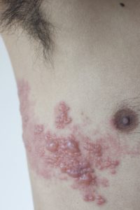 Virus herepes lahko povzroči tudi zelo huda obolenja (foto: iStock)