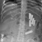 Abdominal-x-ray-showing-7-cylindrical-batteries-5-AAA-and-2-AA-in-the-upper-abdomen