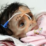 AFP__20230301__AA_01032023_1088267__v1__HighRes__MalnutritionThreatensTheLivesOfMill